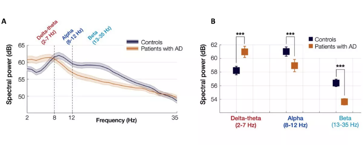 Image of Brain frequency data in patients with Alzheimer’s disease